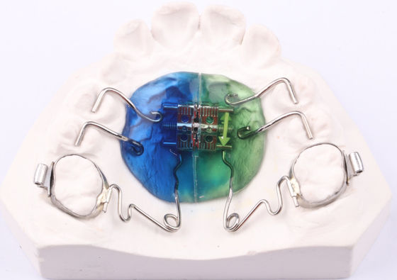 एफडीए पेंडुलम उपकरण Orthodontics पेंडुलम ऑर्थो उपकरण अनुकूलन योग्य